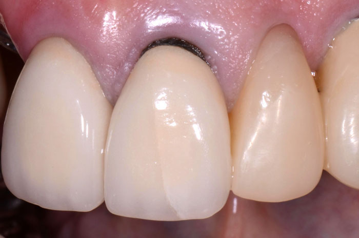 Chân răng sứ bị lộ do kỹ thuật của bác sĩ thực hiện không đúng